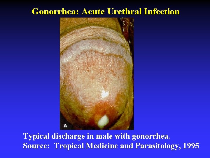 Gonorrhea: Acute Urethral Infection Typical discharge in male with gonorrhea. Source: Tropical Medicine and
