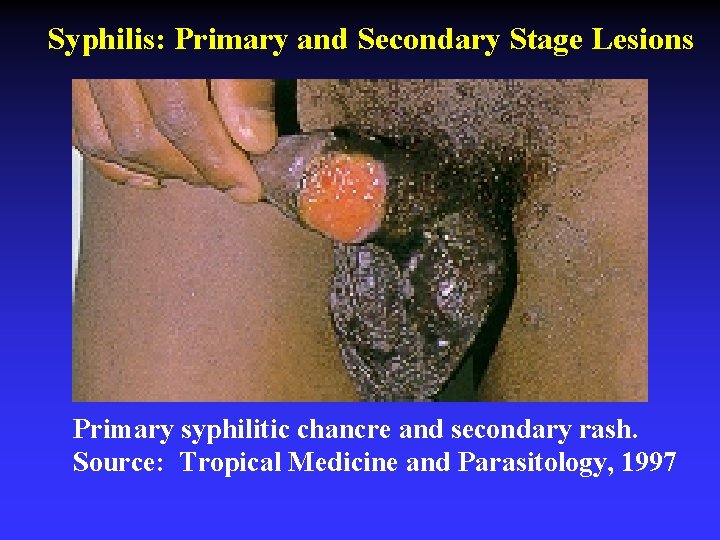 Syphilis: Primary and Secondary Stage Lesions Primary syphilitic chancre and secondary rash. Source: Tropical
