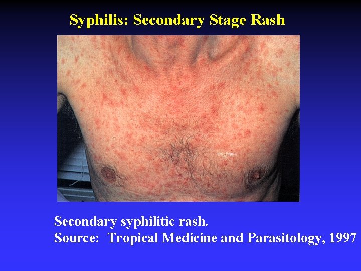 Syphilis: Secondary Stage Rash Secondary syphilitic rash. Source: Tropical Medicine and Parasitology, 1997 