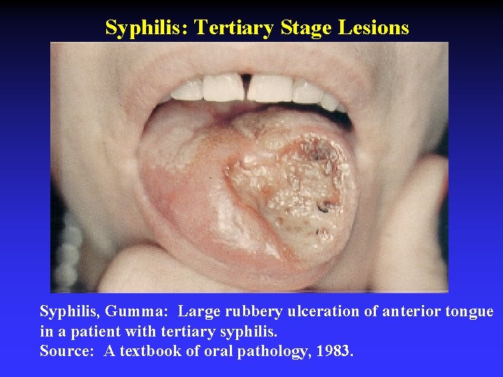 Syphilis: Tertiary Stage Lesions Syphilis, Gumma: Large rubbery ulceration of anterior tongue in a