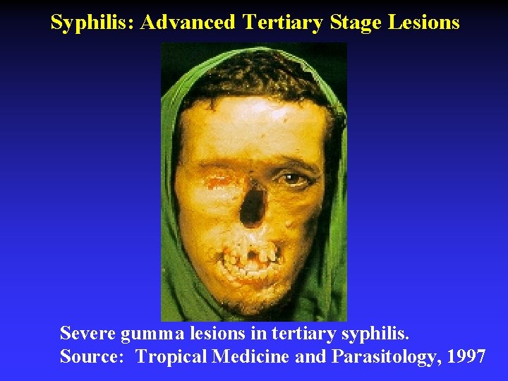 Syphilis: Advanced Tertiary Stage Lesions Severe gumma lesions in tertiary syphilis. Source: Tropical Medicine