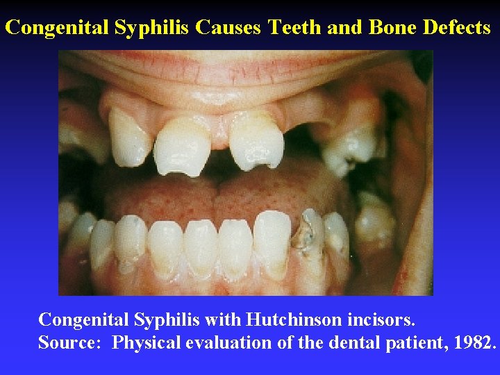Congenital Syphilis Causes Teeth and Bone Defects Congenital Syphilis with Hutchinson incisors. Source: Physical