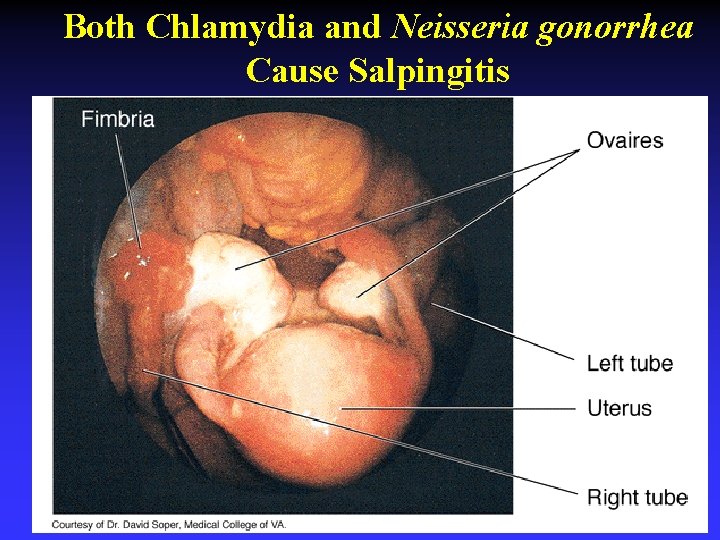 Both Chlamydia and Neisseria gonorrhea Cause Salpingitis 