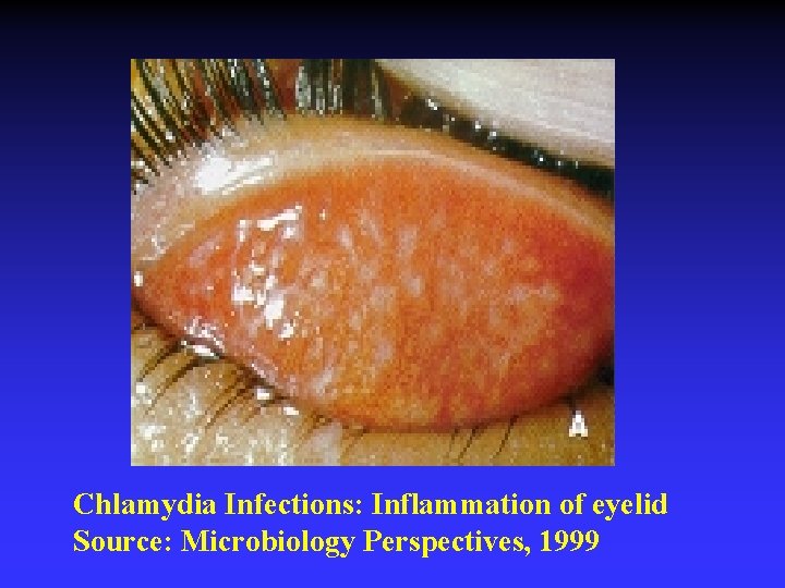 Chlamydia Infections: Inflammation of eyelid Source: Microbiology Perspectives, 1999 