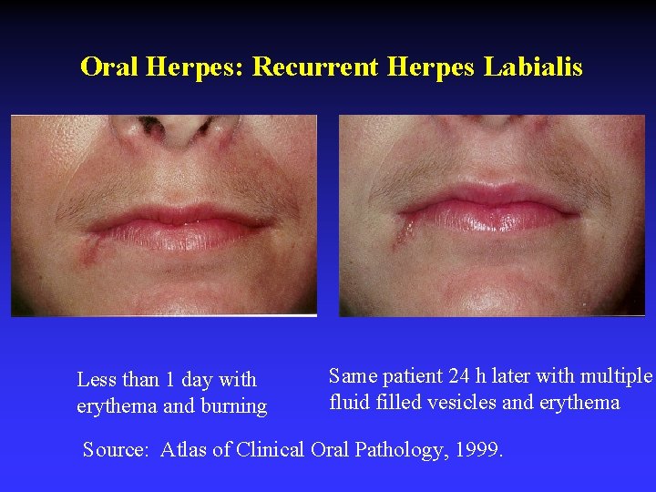 Oral Herpes: Recurrent Herpes Labialis Less than 1 day with erythema and burning Same