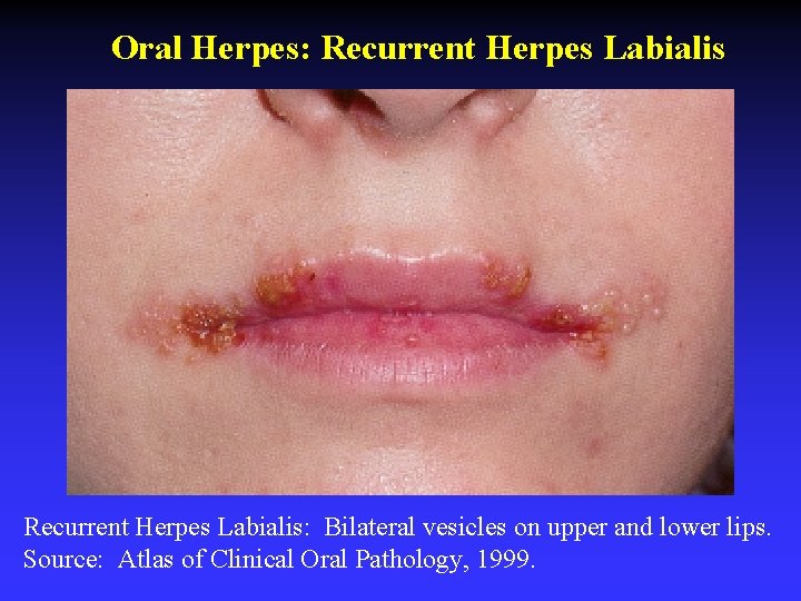 Oral Herpes: Recurrent Herpes Labialis: Bilateral vesicles on upper and lower lips. Source: Atlas