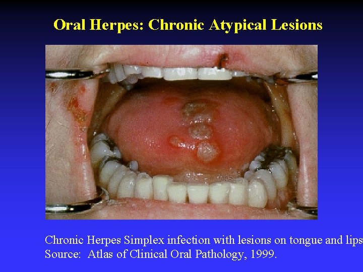 Oral Herpes: Chronic Atypical Lesions Chronic Herpes Simplex infection with lesions on tongue and