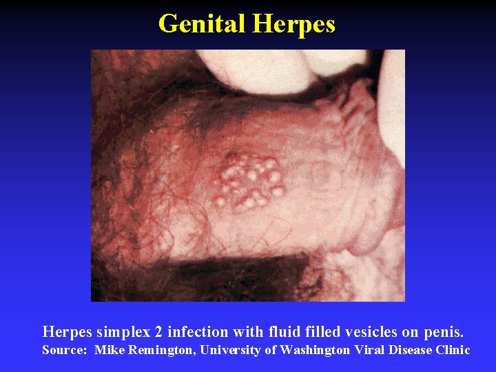 Genital Herpes simplex 2 infection with fluid filled vesicles on penis. Source: Mike Remington,