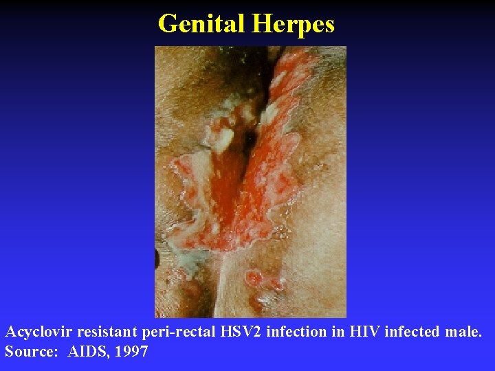 Genital Herpes Acyclovir resistant peri-rectal HSV 2 infection in HIV infected male. Source: AIDS,