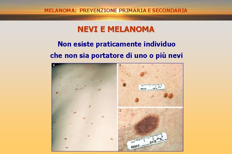 MELANOMA: PREVENZIONE PRIMARIA E SECONDARIA PREVENZIONE SECONDARIA NEVI E MELANOMA Non esiste praticamente individuo