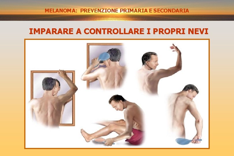 MELANOMA: PREVENZIONE SECONDARIA PRIMARIA E SECONDARIA IMPARARE A CONTROLLARE I PROPRI NEVI 