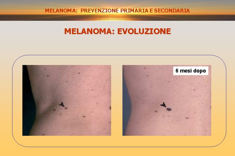 MELANOMA: PREVENZIONE PRIMARIA E SECONDARIA MELANOMA: EVOLUZIONE 6 mesi dopo 