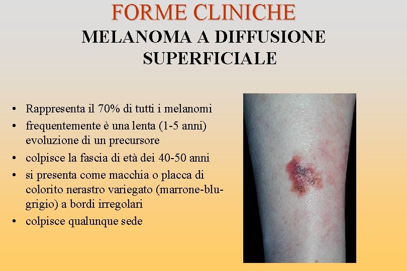 FORME CLINICHE MELANOMA A DIFFUSIONE SUPERFICIALE • Rappresenta il 70% di tutti i melanomi