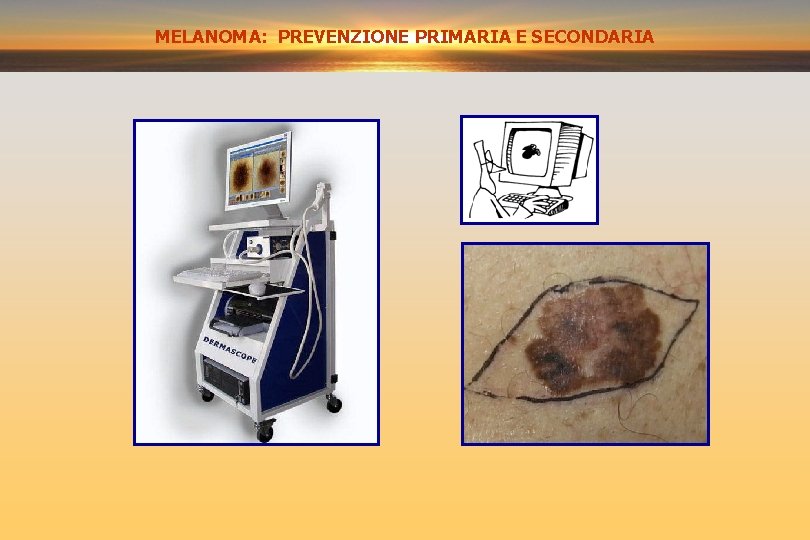 MELANOMA: PREVENZIONE PRIMARIA E SECONDARIA MELANOMA PREVENZIONE SECONDARIA 