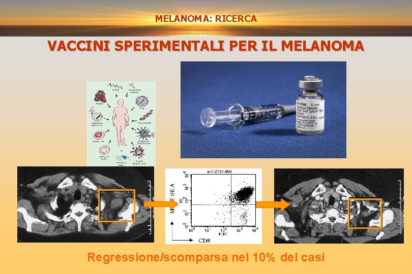 MELANOMA: RICERCA VACCINI SPERIMENTALI PER IL MELANOMA Regressione/scomparsa nel 10% dei casi 