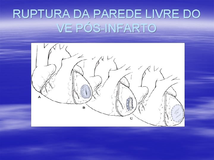 RUPTURA DA PAREDE LIVRE DO VE PÓS-INFARTO RUPTURA DA PAREDE LIVRE DO VE PÓS-INFARTO