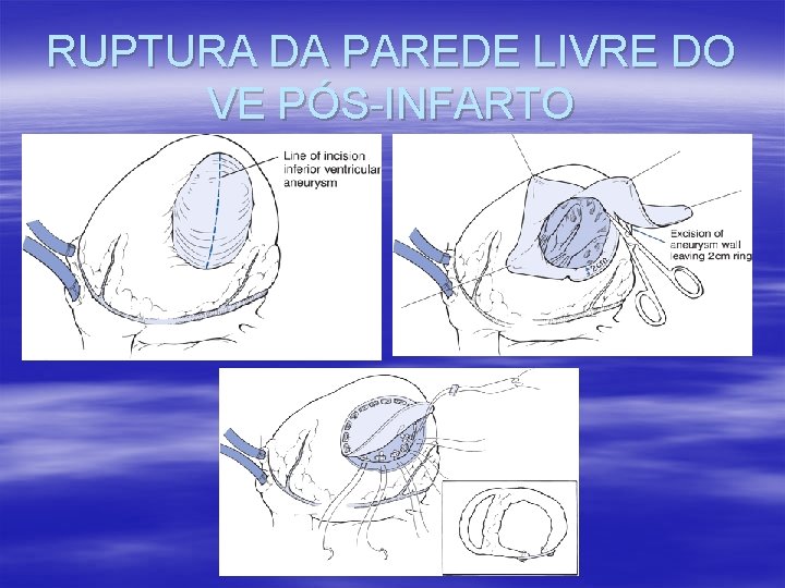RUPTURA DA PAREDE LIVRE DO VE PÓS-INFARTO RUPTURA DA PAREDE LIVRE DO VE PÓS-INFARTO