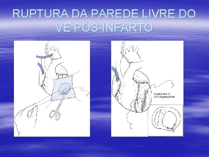 RUPTURA DA PAREDE LIVRE DO VE PÓS-INFARTO RUPTURA DA PAREDE LIVRE DO VE PÓS-INFARTO