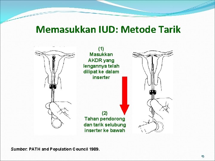 Memasukkan IUD: Metode Tarik (1) Masukkan AKDR yang lengannya telah dilipat ke dalam inserter