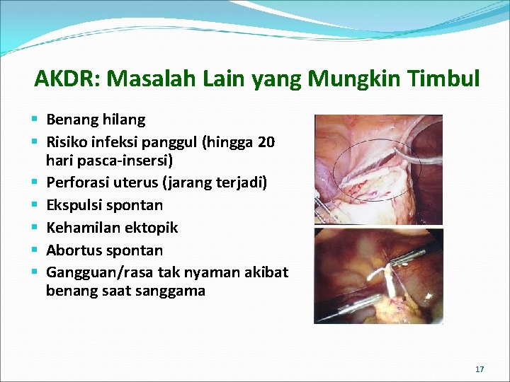 AKDR: Masalah Lain yang Mungkin Timbul § Benang hilang § Risiko infeksi panggul (hingga