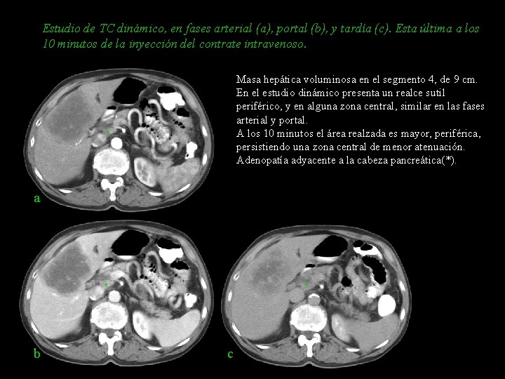 Estudio de TC dinámico, en fases arterial (a), portal (b), y tardía (c). Esta