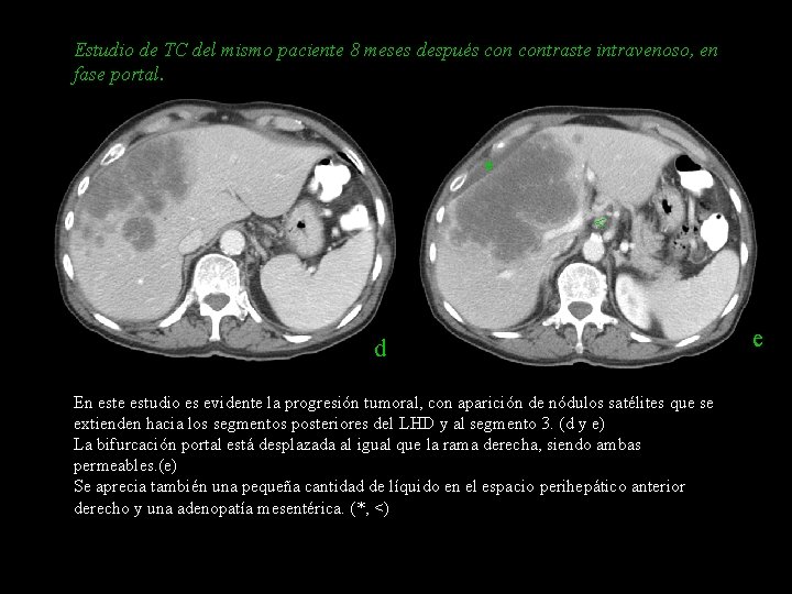 Estudio de TC del mismo paciente 8 meses después contraste intravenoso, en fase portal.