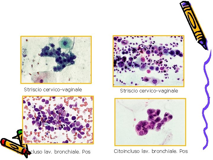 Striscio cervico-vaginale Citoincluso lav. bronchiale. Pos 