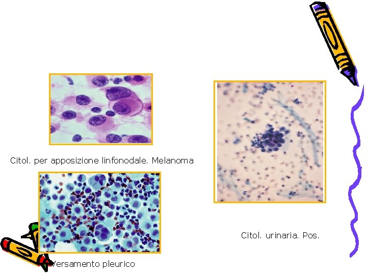 Citol. per apposizione linfonodale. Melanoma Citol. urinaria. Pos. Versamento pleurico 