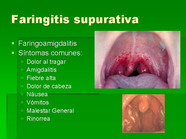 Faringitis supurativa § Faringoamigdalitis § Síntomas comunes: § § § § Dolor al tragar