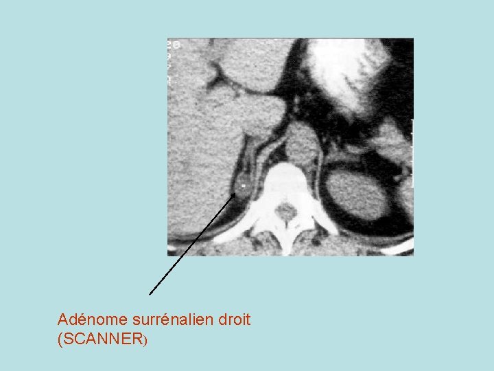 Adénome surrénalien droit (SCANNER) 