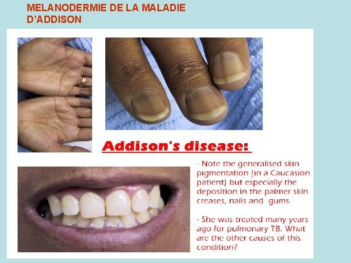 MELANODERMIE DE LA MALADIE D’ADDISON 