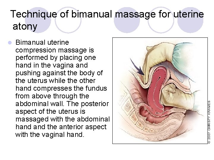 Technique of bimanual massage for uterine atony l Bimanual uterine compression massage is performed