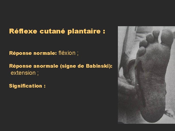 Réflexe cutané plantaire : Réponse normale: fléxion ; Réponse anormale (signe de Babinski): extension Réflexe cutané plantaire : Réponse normale: fléxion ; Réponse anormale (signe de Babinski): extension