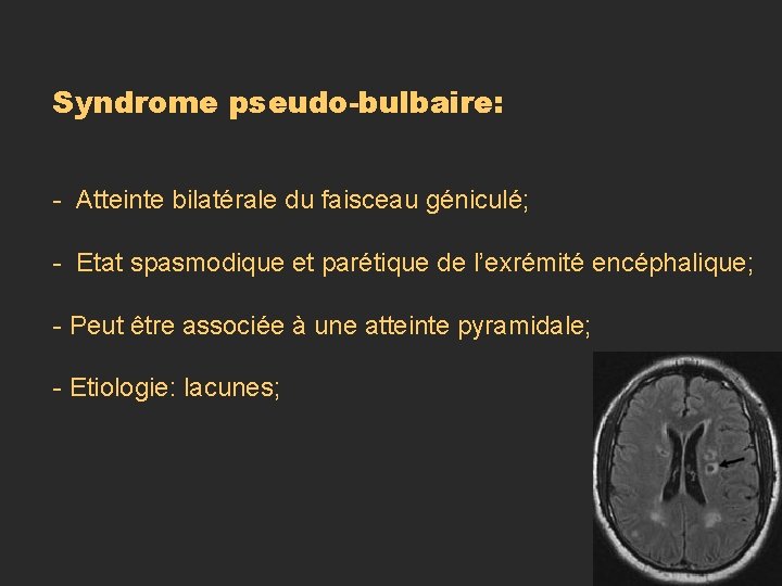 Syndrome pseudo-bulbaire: - Atteinte bilatérale du faisceau géniculé; - Etat spasmodique et parétique de Syndrome pseudo-bulbaire: - Atteinte bilatérale du faisceau géniculé; - Etat spasmodique et parétique de