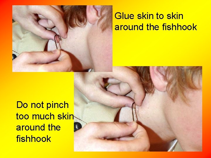 Glue skin to skin around the fishhook Do not pinch too much skin around