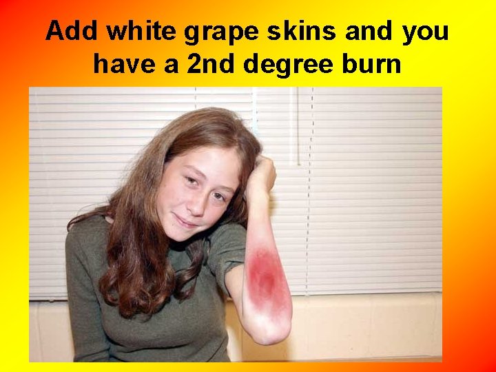 Add white grape skins and you have a 2 nd degree burn 