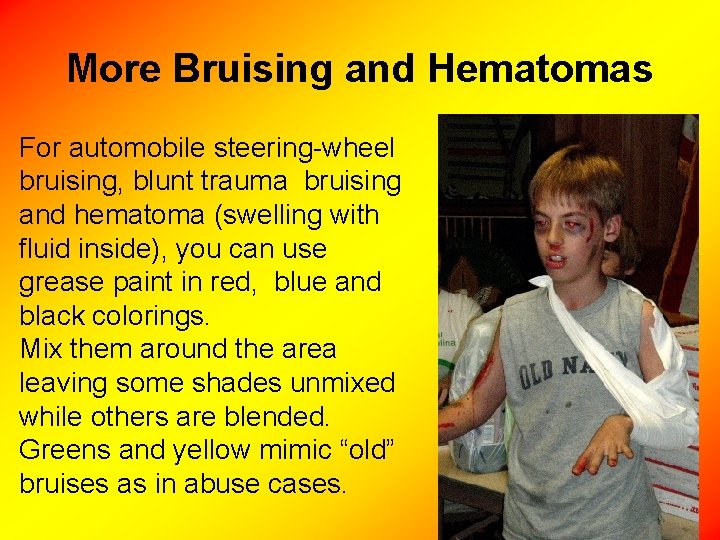 More Bruising and Hematomas For automobile steering-wheel bruising, blunt trauma bruising and hematoma (swelling