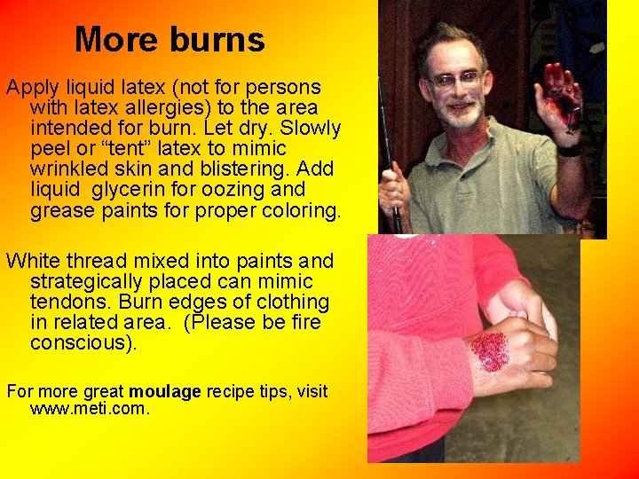 More burns Apply liquid latex (not for persons with latex allergies) to the area