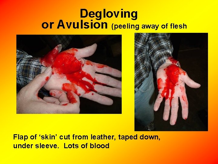 Degloving or Avulsion (peeling away of flesh Flap of ‘skin’ cut from leather, taped