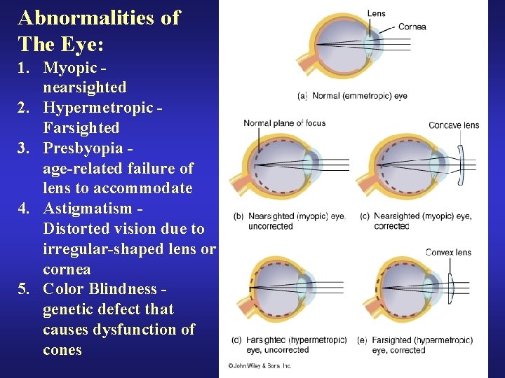 Abnormalities of The Eye: 1. Myopic nearsighted 2. Hypermetropic Farsighted 3. Presbyopia age-related failure