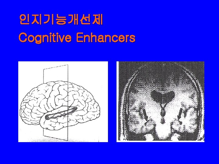 인지기능개선제 Cognitive Enhancers 