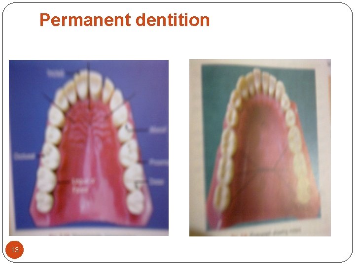 Permanent dentition 13 Permanent dentition 13