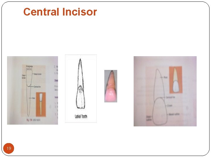 Central Incisor 19 Central Incisor 19
