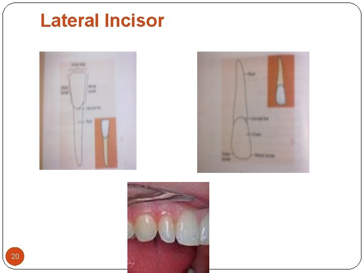 Lateral Incisor 20 Lateral Incisor 20