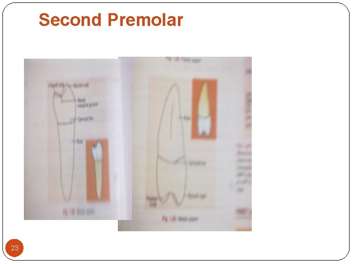 Second Premolar 23 Second Premolar 23