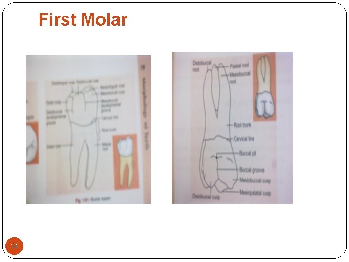 First Molar 24 First Molar 24