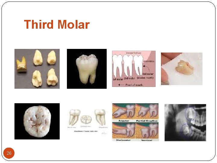 Third Molar 26 Third Molar 26