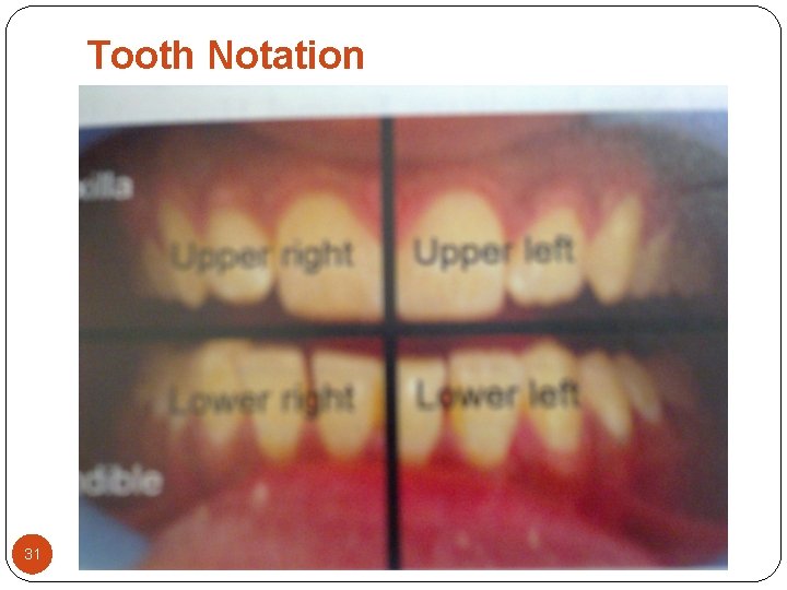 Tooth Notation 31 Tooth Notation 31