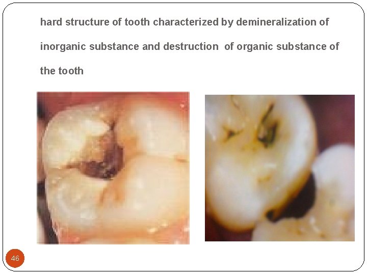 hard structure of tooth characterized by demineralization of inorganic substance and destruction of organic hard structure of tooth characterized by demineralization of inorganic substance and destruction of organic