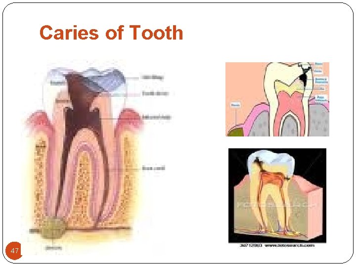 Caries of Tooth 47 Caries of Tooth 47